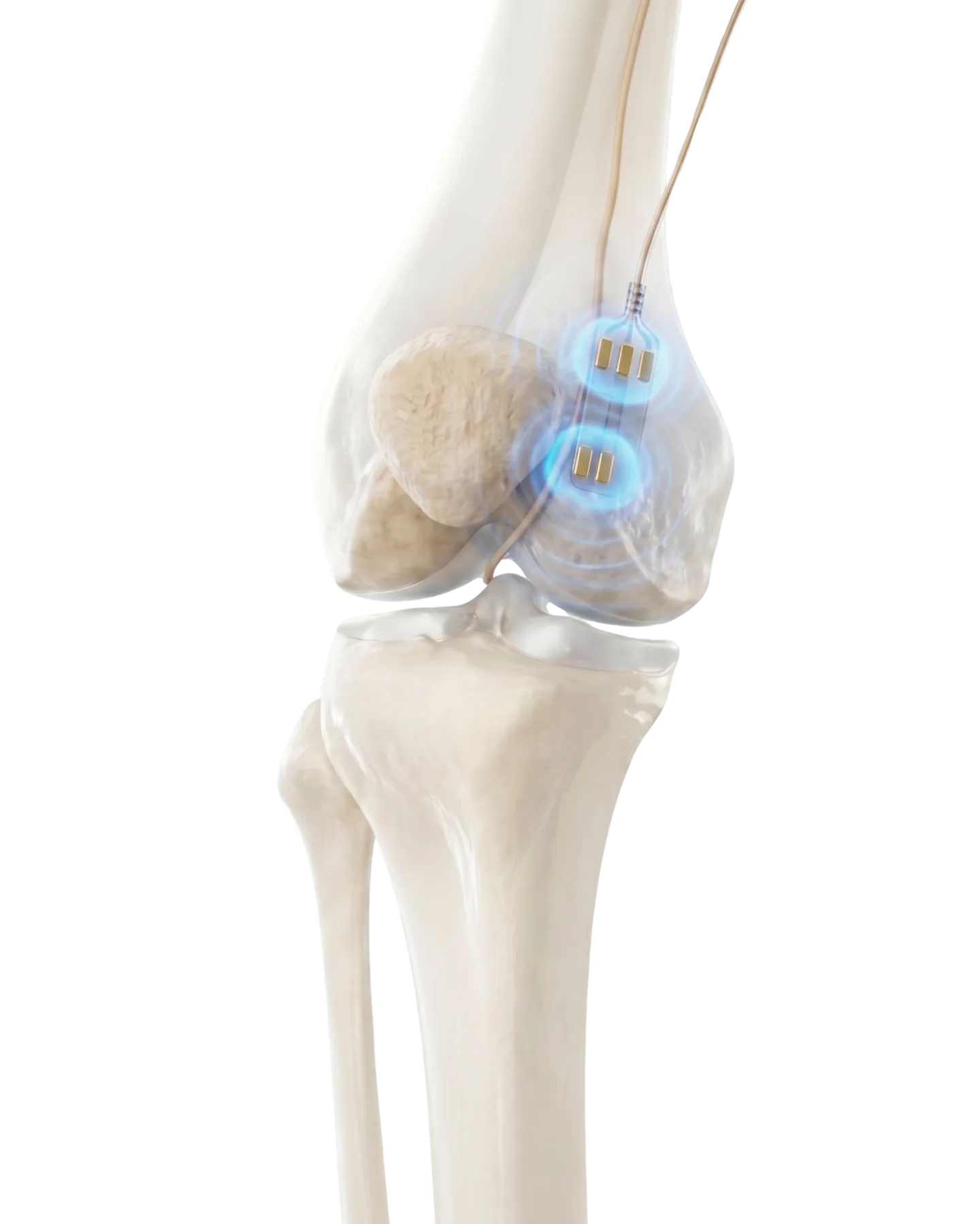 Anatomical render of a knee, with a thin lead running down to two contacts lit beside the joint.