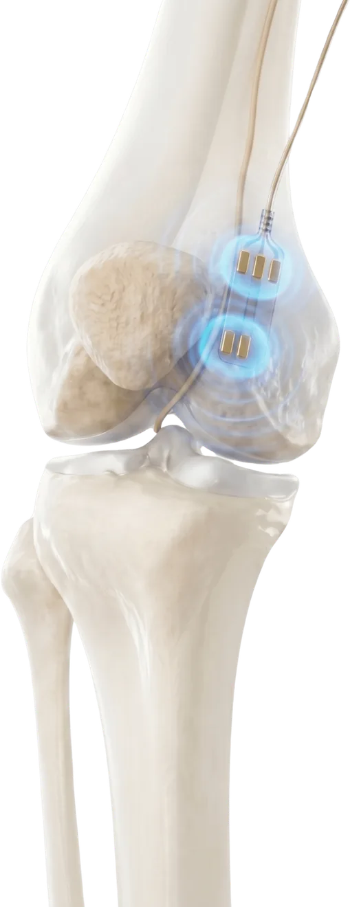 Anatomical render of a leg: a thin lead runs down to two small contacts resting against the bone beside the knee, each ringed by a blue glow standing for the stimulation field.